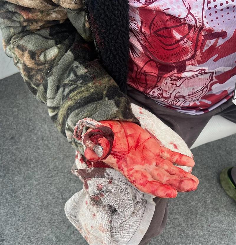 Be extra careful removing hooks from sharks. A black-tip latched onto Dave and wouldn't let go. 8 puncture wounds and super glue for the bigger cuts - photo © Fisho's Tackle World Hervey Bay